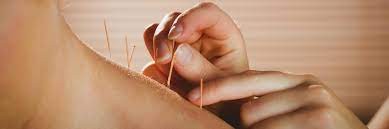 Acupuncture